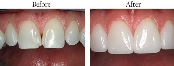 Kendale Lakes Before and After Dental Implants